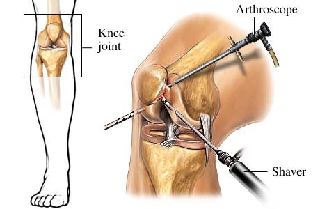Artroskopija kolena